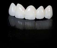 Press N’ Go Veneers Partial